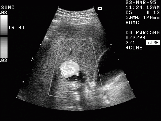 Ultraschallbild eines Leberhämangioms - Sonographie Ultraschallbild eines Leberhämangioms - Sonographie